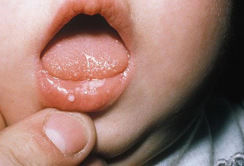 Mách mẹ 4 cách chữa nhiệt miệng cho trẻ khỏi ngay tức thì – Áp dụng ngay Đừng Bỏ Qua