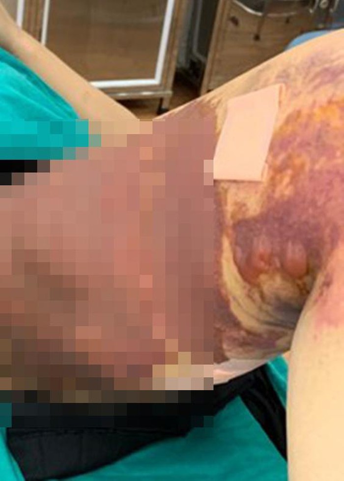 Một nữ bệnh nhân bị tai biến thâm đen cả người khi hút mỡ tại thẩm mỹ viện Việt Hàn