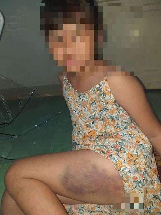 Tạm đình chỉ công tác nữ giáo viên đánh bé gái lớp 3 bầm dập đùi